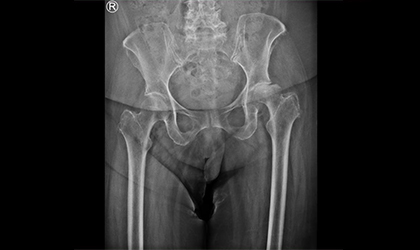 X-ray showing rapid hip collapse
