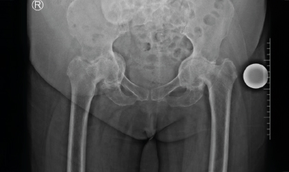Protrusio Hip X-ray