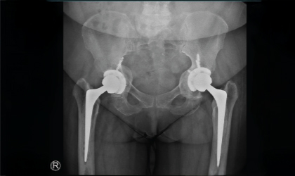 Bilateral Knee Replacement Case Study