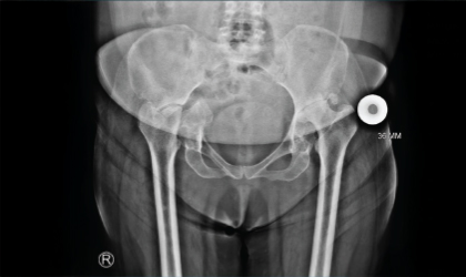 Bilateral Hip Damage X-ray