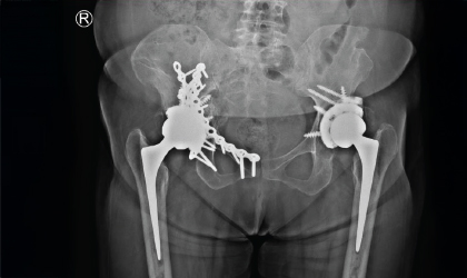 Revision Knee Surgery Case Study