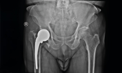 Fractured Stem X-ray with Multiple Breaks