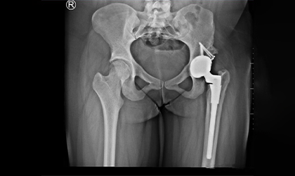 S-ROM Hip Replacement