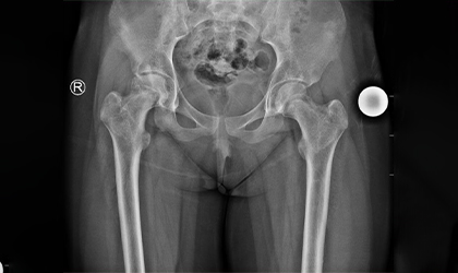 Joint Replacement Case Study