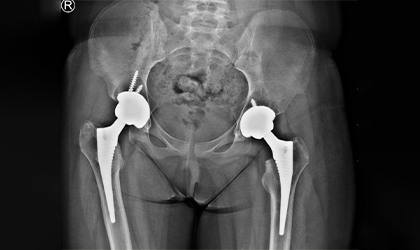 Hip Arthroscopy Case Study