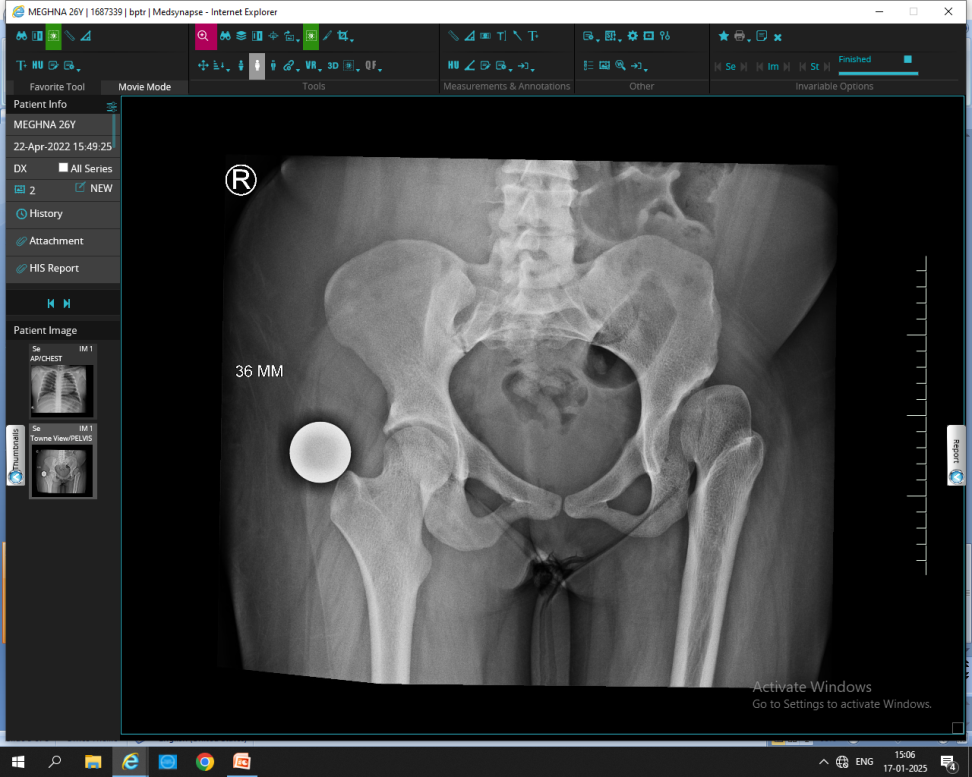 Joint Replacement Case Study